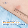В Україні впроваджуються нові шкірні тести для виявлення туберкульозної інфекції