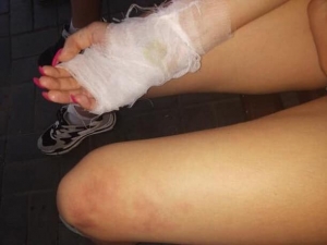 15-летняя девушка упала в костер на празднике Ивана Купала